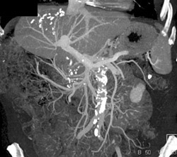 Prior Right Hepatectomy - CTisus CT Scan