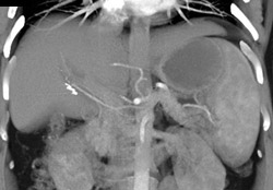 Right Hepatic Artery Directly Off Aorta - CTisus CT Scan