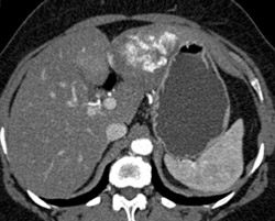 Hemangioma - CTisus CT Scan