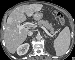 Portal Vein Thrombosis - CTisus CT Scan