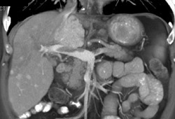 Portal Vein Clot in 3D - CTisus CT Scan