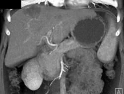 Metastatic Carcinoid Tumor - CTisus CT Scan