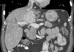 Metastatic Carcinoid Tumor With Multiple Lesions - CTisus CT Scan