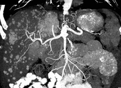 3D of Vascular Liver Mets (carcinoid) - CTisus CT Scan