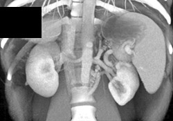 Cirrhosis With Collaterals Near the Left Kidney - CTisus CT Scan