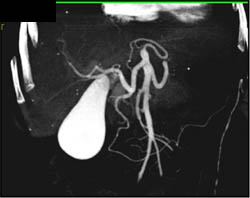 VRT of the Gallbladder - CTisus CT Scan