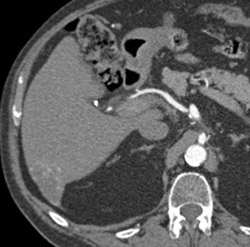 Hemangioma - CTisus CT Scan