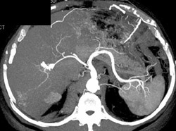 Hemangioma - CTisus CT Scan