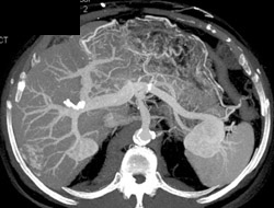 Hemangioma - CTisus CT Scan