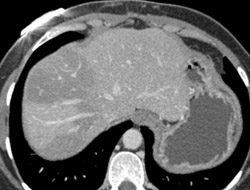 Focal Hepatic Change Due to Fatty Liver - CTisus CT Scan