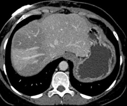 Fatty Liver - CTisus CT Scan