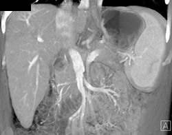 Parenchymal Changes in the Liver - CTisus CT Scan