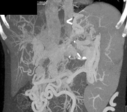 Cavernous Transformation of the Portal Vein (CTPV) With Extensive Collaterals - CTisus CT Scan