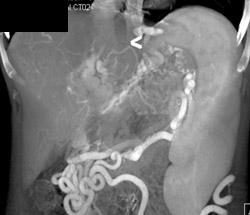 Cavernous Transformation of the Portal Vein (CTPV) and Varices - CTisus CT Scan