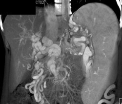 Gastroepiploic Varices Due to Cavernous Transformation of the Portal Vein (CTPV) - CTisus CT Scan