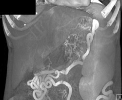 Cavernous Transformation of the Portal Vein (CTPV) With Incredible Varices - CTisus CT Scan