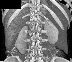 Extensive Varices - CTisus CT Scan