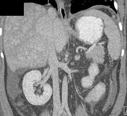 Budd-Chiari on Late Phase Images - CTisus CT Scan