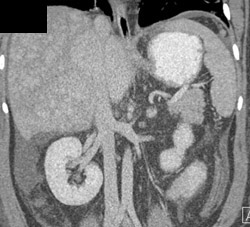 Patchy Enhancement in Budd-Chiari Syndrome - CTisus CT Scan