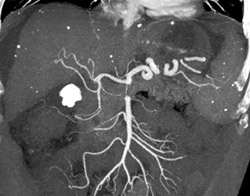 Normal Hepatic Aa. Note Granulomas in Liver and Spleen - CTisus CT Scan