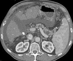 Cirrhosis With Pancreatic Pseudocysts - CTisus CT Scan