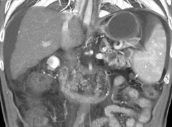 Cirrhosis - CTisus CT Scan