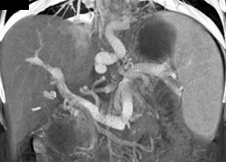 Gastric Varices - CTisus CT Scan