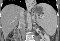 Esophageal Varices - CTisus CT Scan