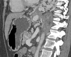 Esophageal Varices - CTisus CT Scan