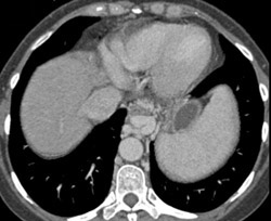 Esophageal Varices - CTisus CT Scan