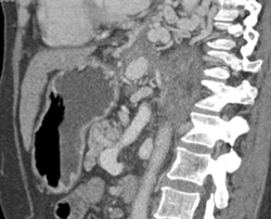 Esophageal Varices in 3D - CTisus CT Scan