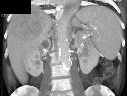 Celiac Artery Aneurysm as Well as Hepatoma - CTisus CT Scan