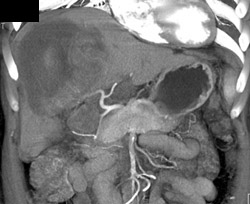 Hepatoma With Bleed - CTisus CT Scan