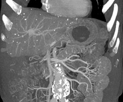 Granulomatous Disease - CTisus CT Scan