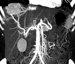 Av Shunting Due to Metastatic Islet Cell Tumor - CTisus CT Scan