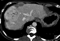 Liver Metastases Wash Out on Venous Phase Images - CTisus CT Scan