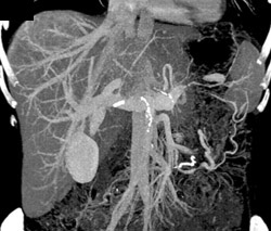 Hepatic Vasculature - CTisus CT Scan