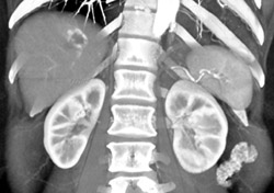 Hemangioma - CTisus CT Scan