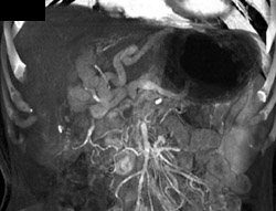 Cavernous Transformation of the Portal Vein - CTisus CT Scan