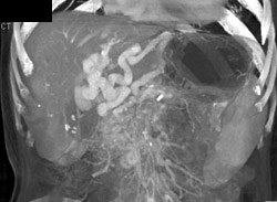 Cavernous Transformation of the Portal Vein - CTisus CT Scan