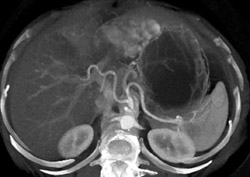 Hemangioma - CTisus CT Scan