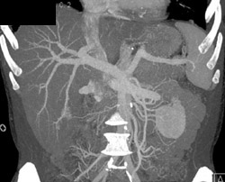 Hemangioma - CTisus CT Scan