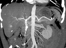 Hemangioma - CTisus CT Scan