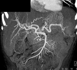 Irregular Vessels in the Liver - CTisus CT Scan