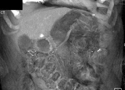 Hemangioma - CTisus CT Scan