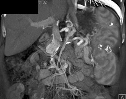 Normal Spleen - CTisus CT Scan