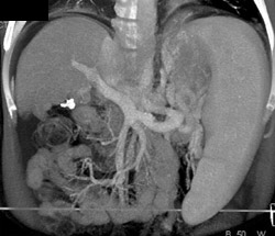 Portal Vein Thrombosis - CTisus CT Scan