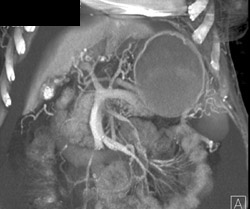 Cavernous Transformation of the Portal Vein - CTisus CT Scan