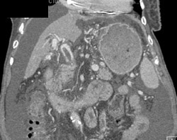 Portal Vein, Splenic Vein and Superior Mesenteric Vein (SMV) Clot - CTisus CT Scan