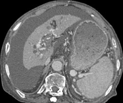 Clots in Portal Vein, Splenic Vein, and Superior Mesenteric Vein (SMV) - CTisus CT Scan